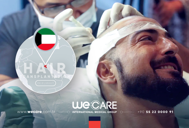 Hair Transplantation In Kuwait WE CARE